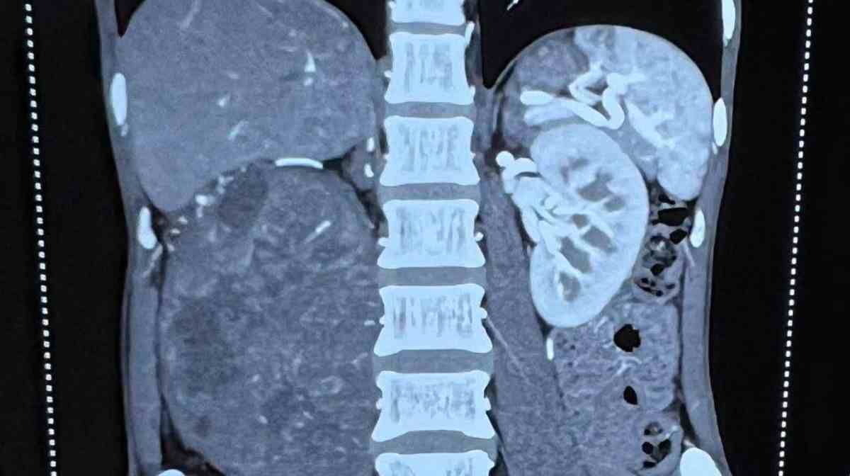 kidney-tumer-2