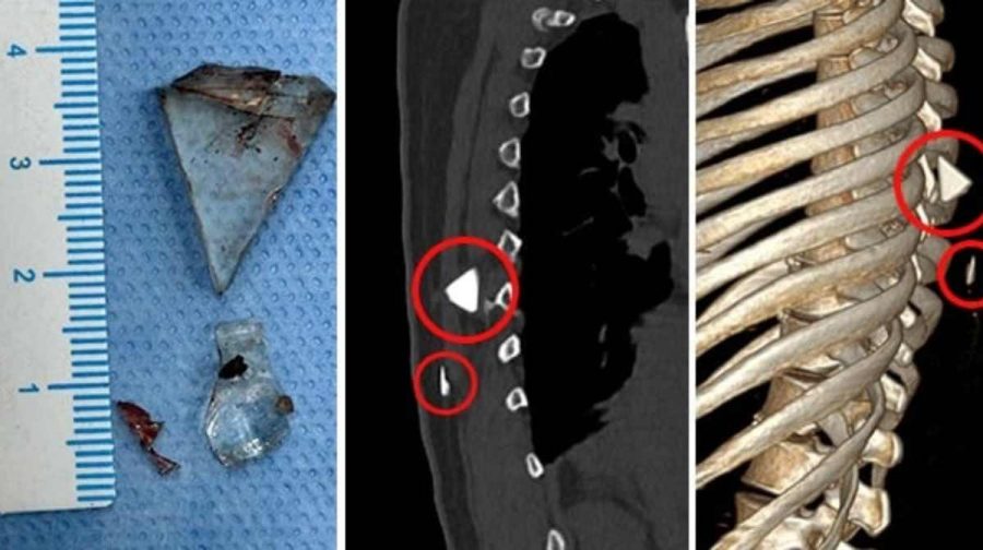 spine-surgery-glass