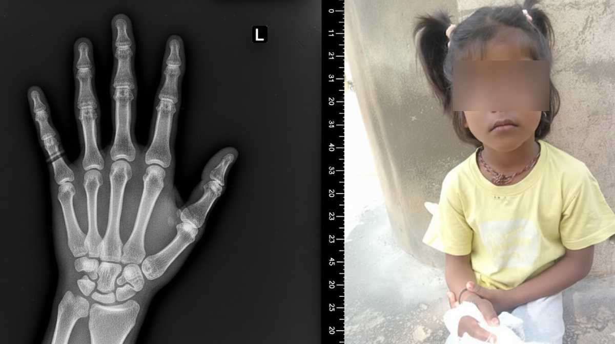 AI Generated Image. 2. പരുക്കേറ്റ വിദ്യാര്‍ഥിനി(Image Credit: NDTV)