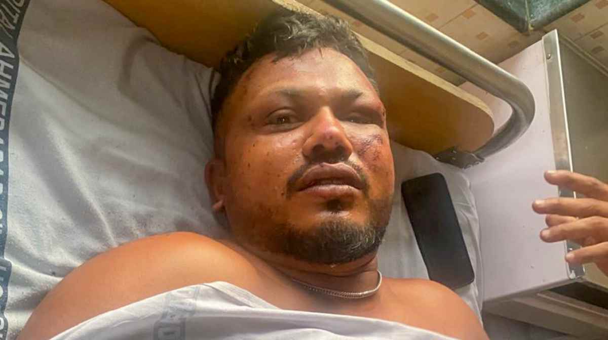 **EDS: THIRD PARTY** In this image via MHA, is seen Vishwash Kumar Ramesh, the lone survivor of the Air India plane crash, receives treatment at a hospital in Ahmedabad, Thursday, June 12, 2025. The Ahmedabad-London Air India flight carrying 242 passengers crashed moments after taking off from the Ahmedabad airport. (MHA via PTI Photo)  (PTI06_12_2025_000390A)