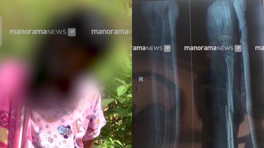 hand-amputation-case-2