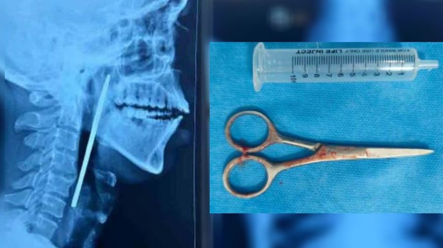 patient-swallows-scissors