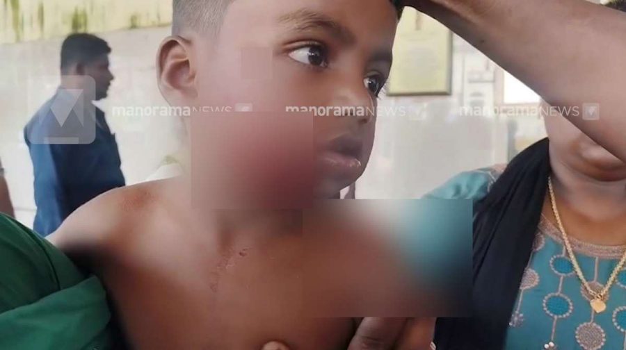 stray-dog-attacks-three-year-old-child-kollam-pattazhi-kottarakkara