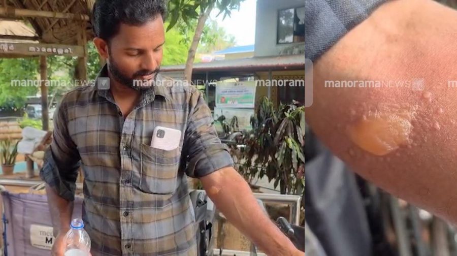 thamarassery-sunburn-2