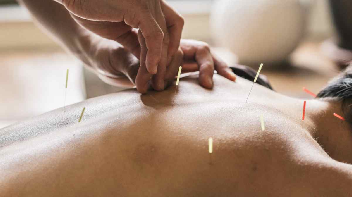 acupuncture