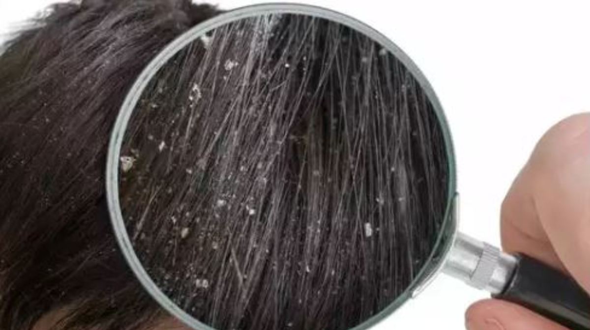 Dandruff-JPG