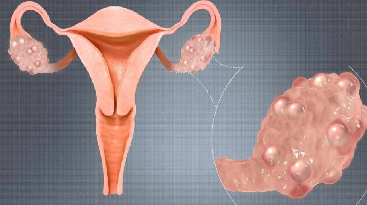 ayurvedic-treatment-for-pcod