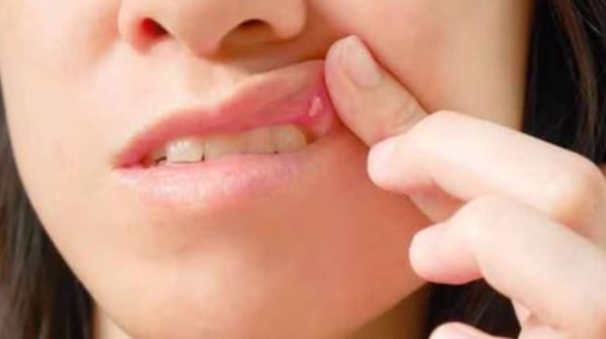 mouth-ulcer