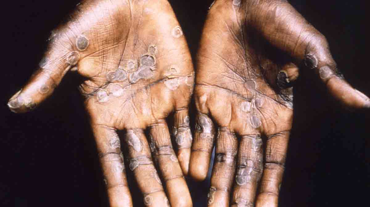 HEALTH-MONKEYPOX/