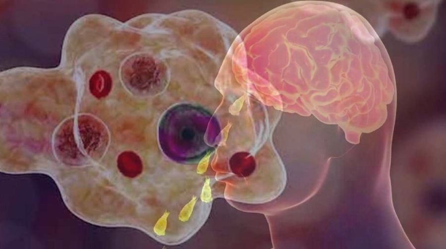 amoebic-encephalitis-2