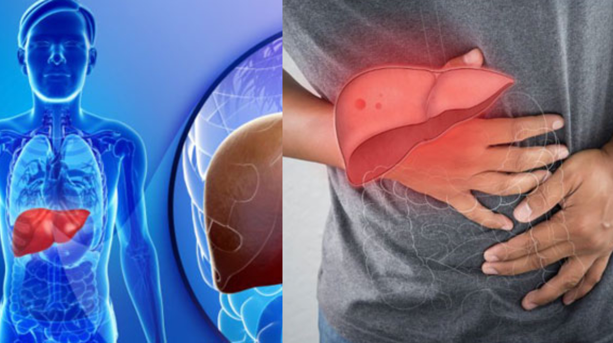 fatty-liver