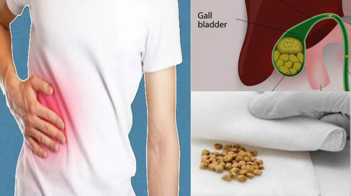 gall-blader-stones-health