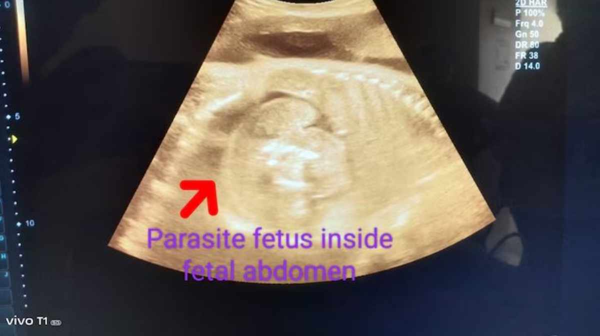 foetus