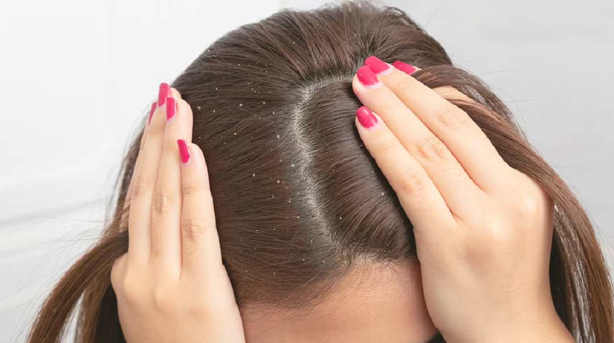 dandruff-solutions