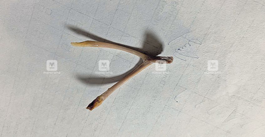 thiruvananthapuram-bone-stuck-in-throat-removed.jpg.image.845.440 thiruvananthapuram-bone-stuck-in-throat-removed.jpg.image.845.440
