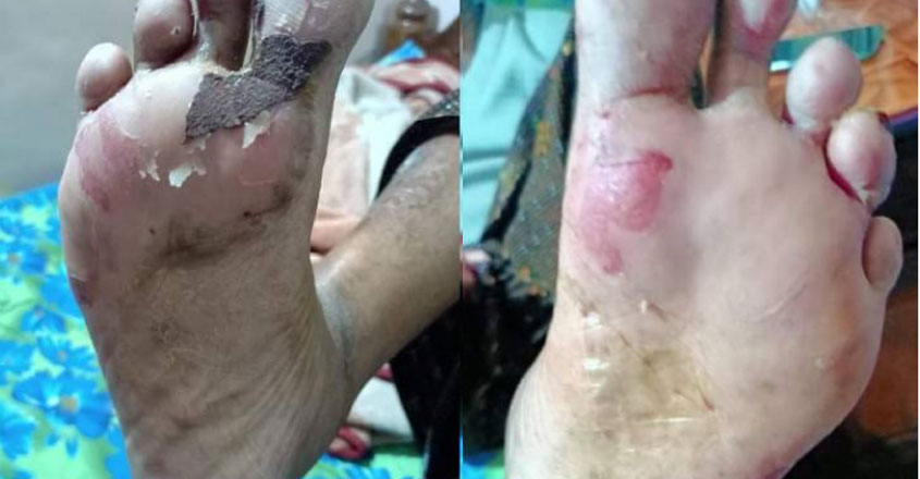leg-injury