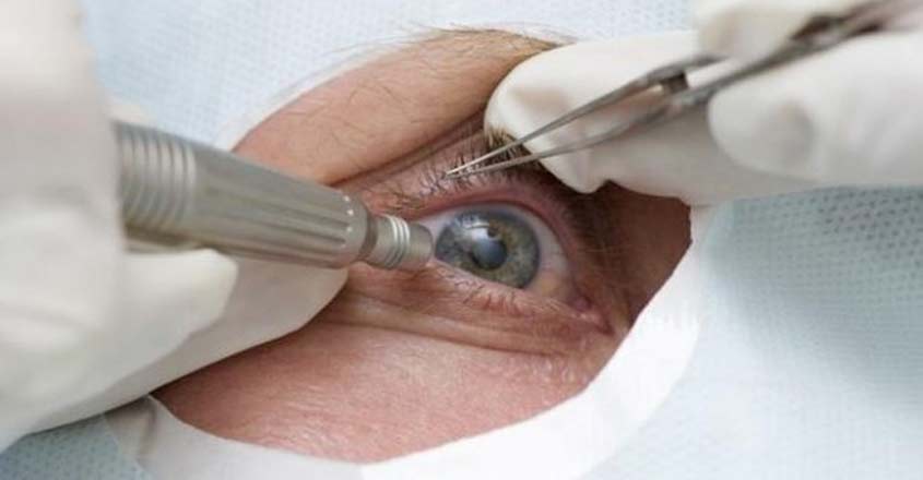 cataract-surgery-main